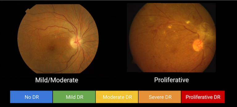 Five levels of DR severity detected on retinal images