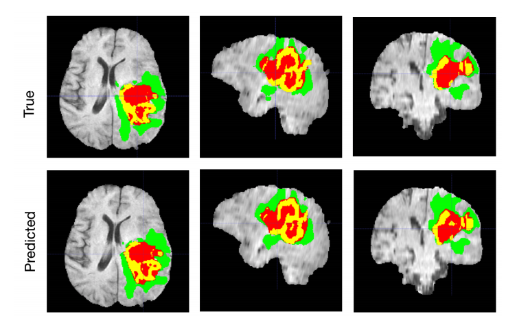 Brain tumore segmentation