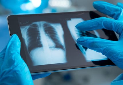 AI lung disease detection