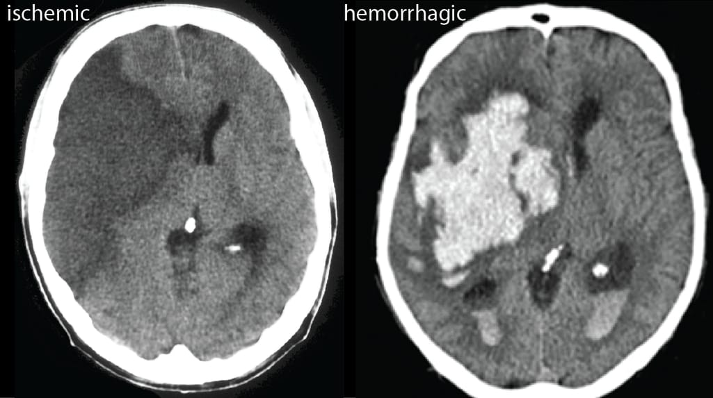 In most cases, AI algorithms sufficiently differentiate ischemic strokes caused by blood clots from hemorrhagic strokes caused by bleeding