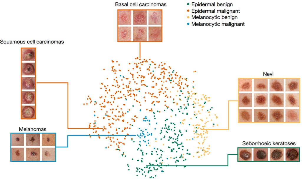 That’s how a CNN developed at Stanford classifies skin lesions from images